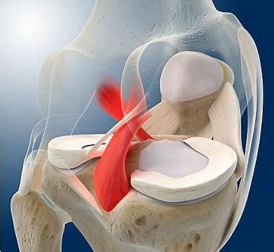 Redefining ACL Reconstruction: The Case for Anatomical Techniques