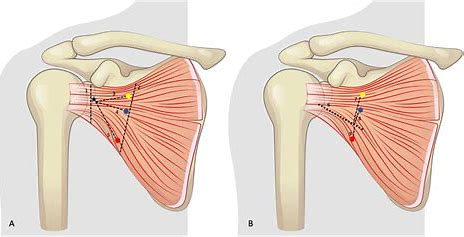 The Latarjet Procedure for Recurrent Shoulder Instability in Athletes