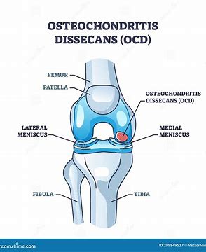 Arthroscopic Treatment of Osteochondritis Dissecans (OCD): Global Techniques and Clinical Advances