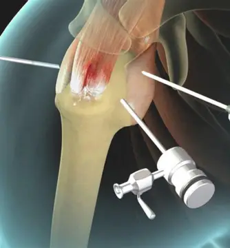 The High Outside-Lateral Portal (HOLP) Technique: Advancing Youth Sports Medicine